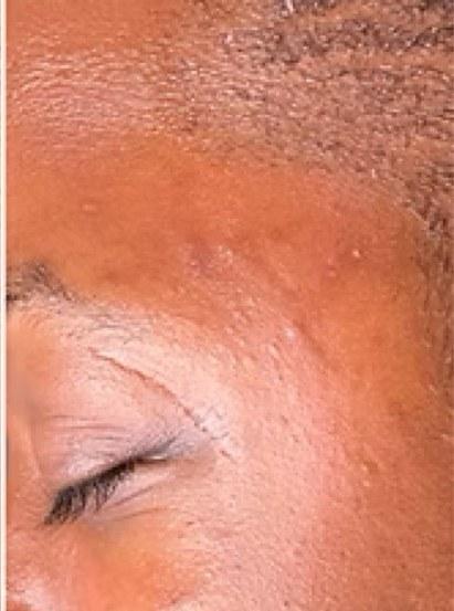 The same client in August 2022, showing even skin tone, smooth texture, and healthy skin.