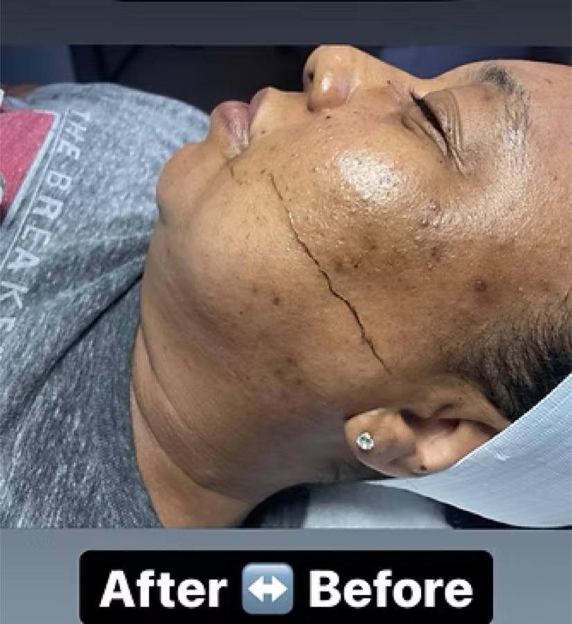 Before and after of a dermaplaning treatment showing noticeably smoother, clearer skin.